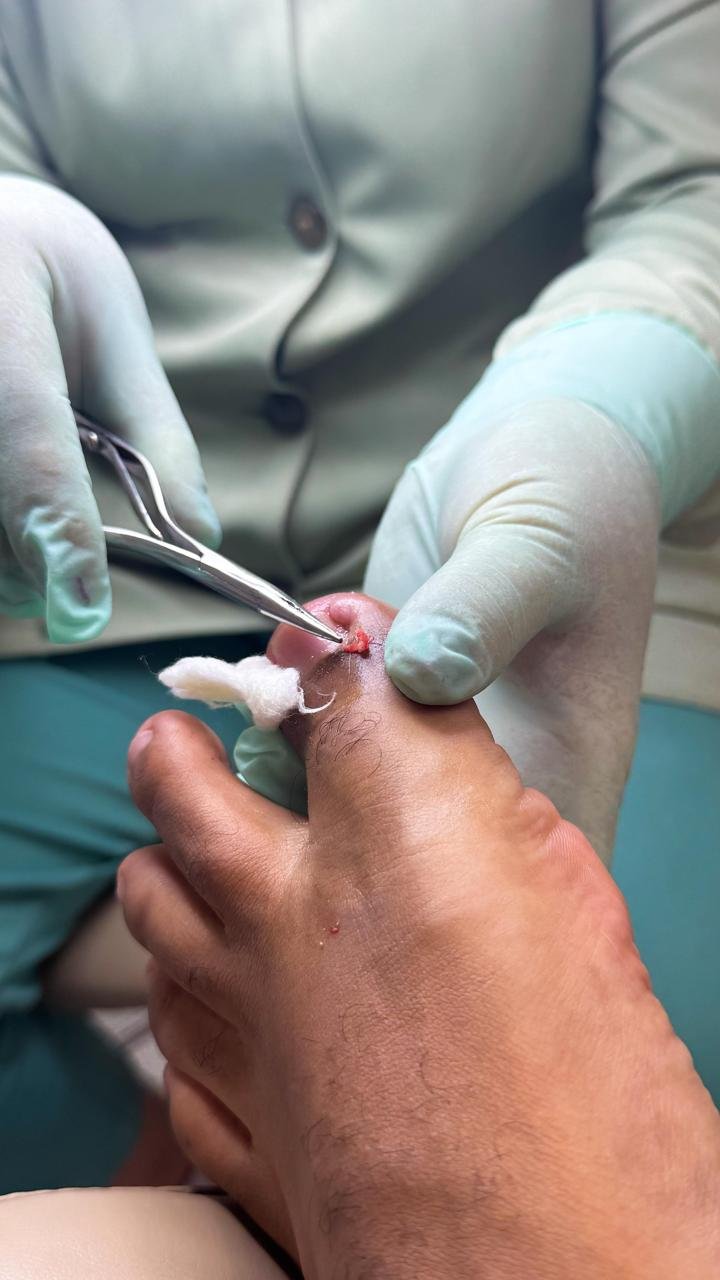 Espiculaectomia — remoção de espículas ungueais